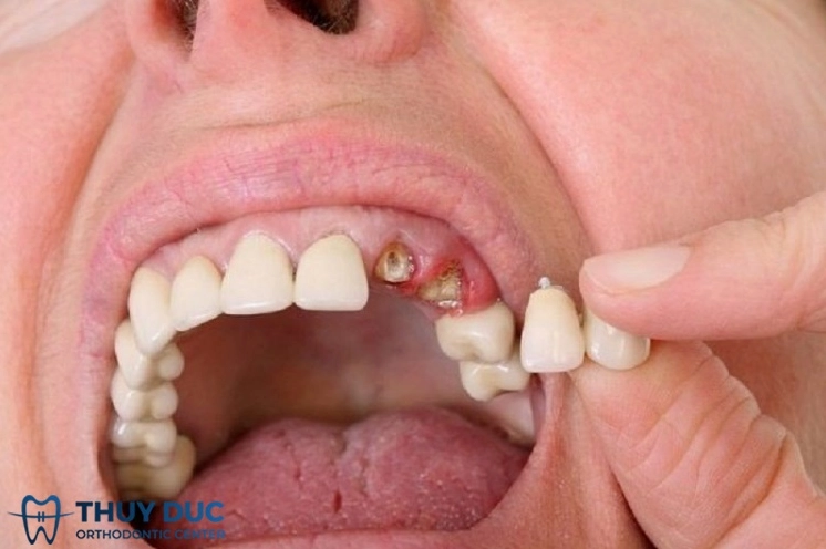 2.3. Mơ thấy rụng răng hàm trên 1