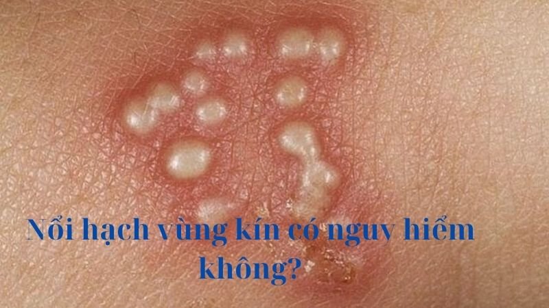 nổi hạch ở vùng kín là gì