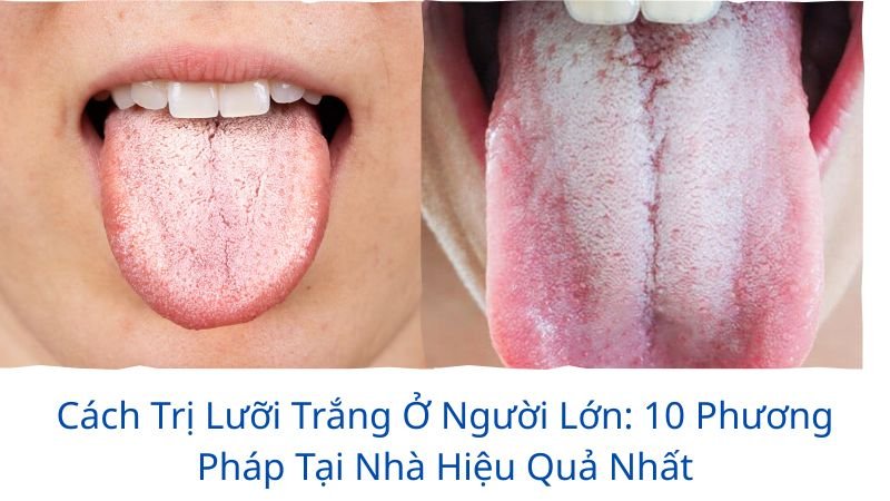 cách trị lưỡi trắng ở người lớn