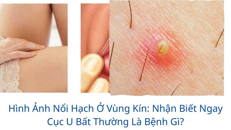 hình ảnh nổi hạch ở vùng kín