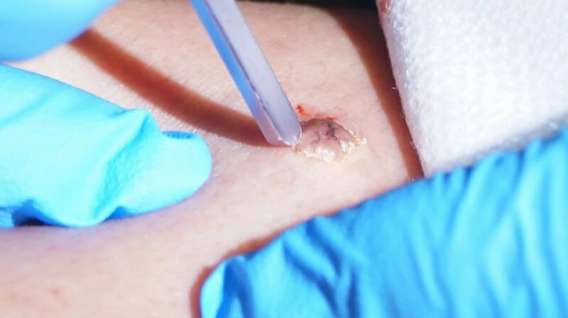 Nên tẩy nốt ruồi ở gót chân nếu nó có dấu hiệu của u ác tính