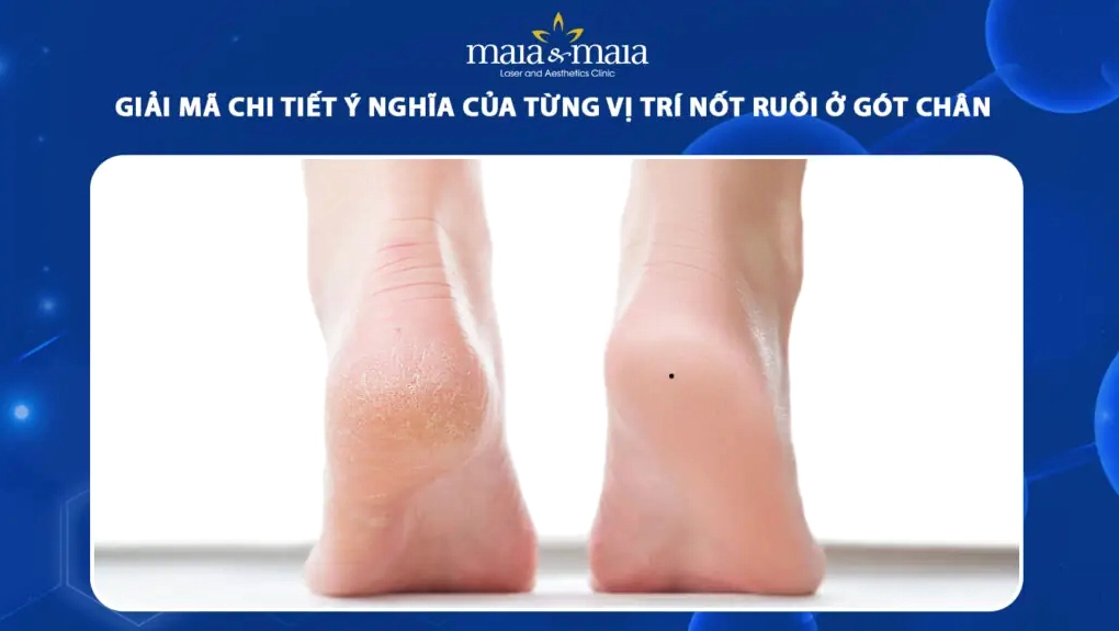 nốt ruồi ở gót chân