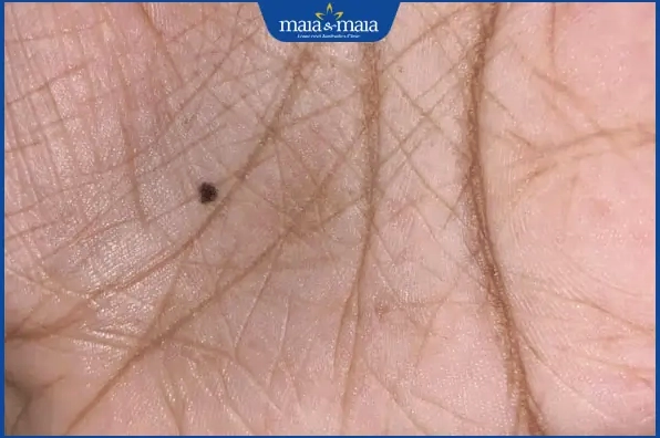 nốt ruồi trong lòng bàn tay