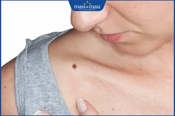 nốt ruồi xương quai xanh nữ