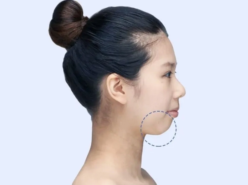 Ảnh minh họa khuôn mặt có cằm ngắn