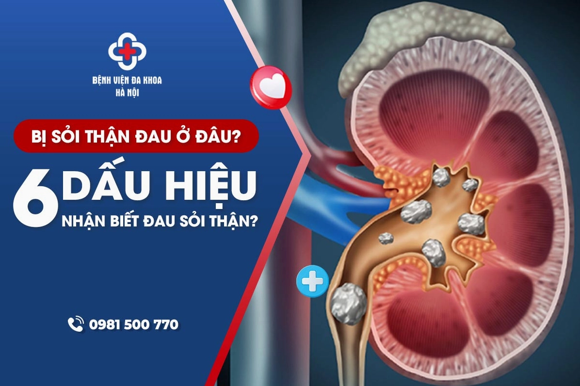 Đau vùng hông lưng do sỏi thận