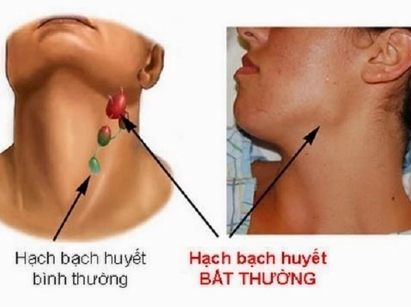 Bác sĩ đang thăm khám cho bệnh nhân về hạch bạch huyết