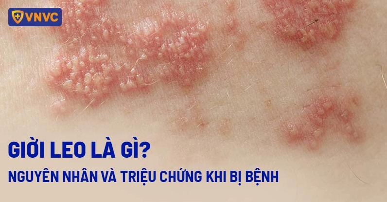 dau-hieu-bi-gioi-leo-nhan-biet-som-phong-ngua-hieu-qua_264
