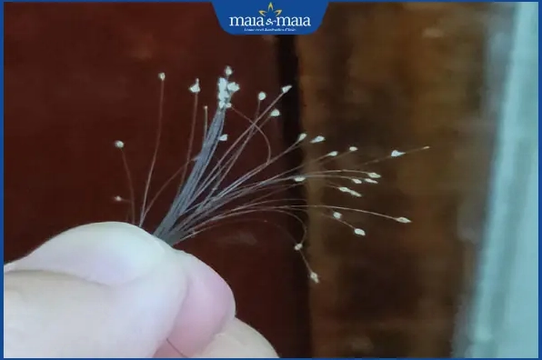 Dấu hiệu chân tóc có hạt trắng