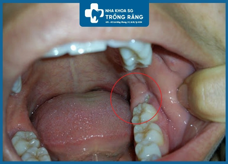 Dấu hiệu răng khôn mọc ngầm