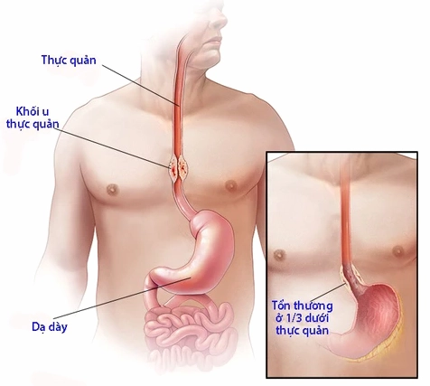 Hình ảnh minh họa các phần của thực quản