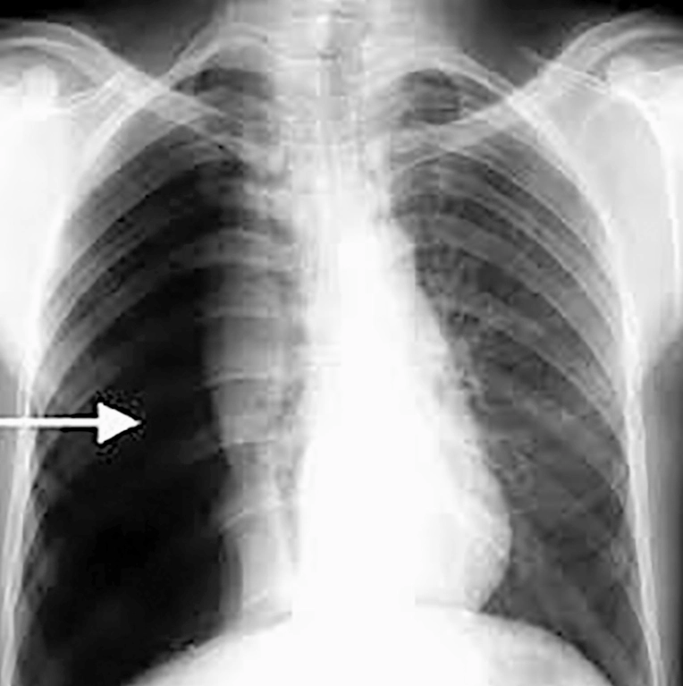 Hình ảnh minh họa cấu trúc phổi và khoang màng phổi bị tràn khí