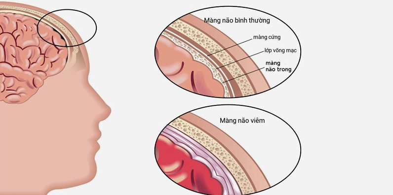 Hình ảnh minh họa màng não bị viêm