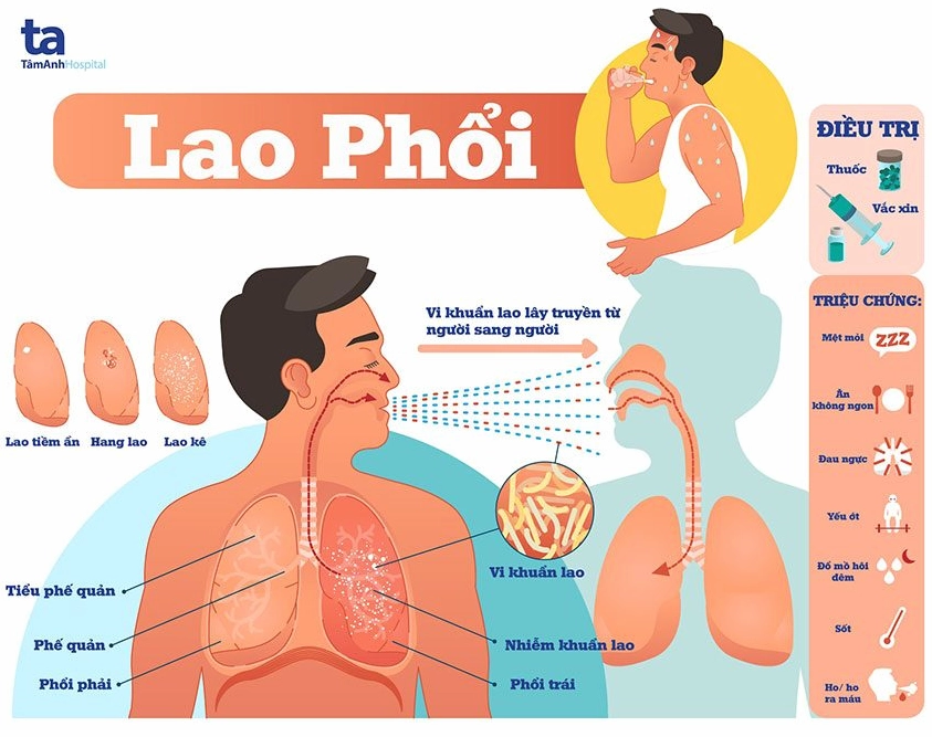 Hình ảnh minh họa người bệnh ho khan kéo dài
