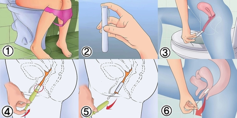 Hình ảnh minh họa tampon