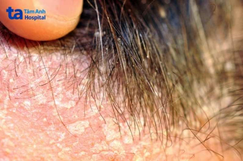 Hình ảnh minh họa tình trạng viêm da tiết bã da đầu