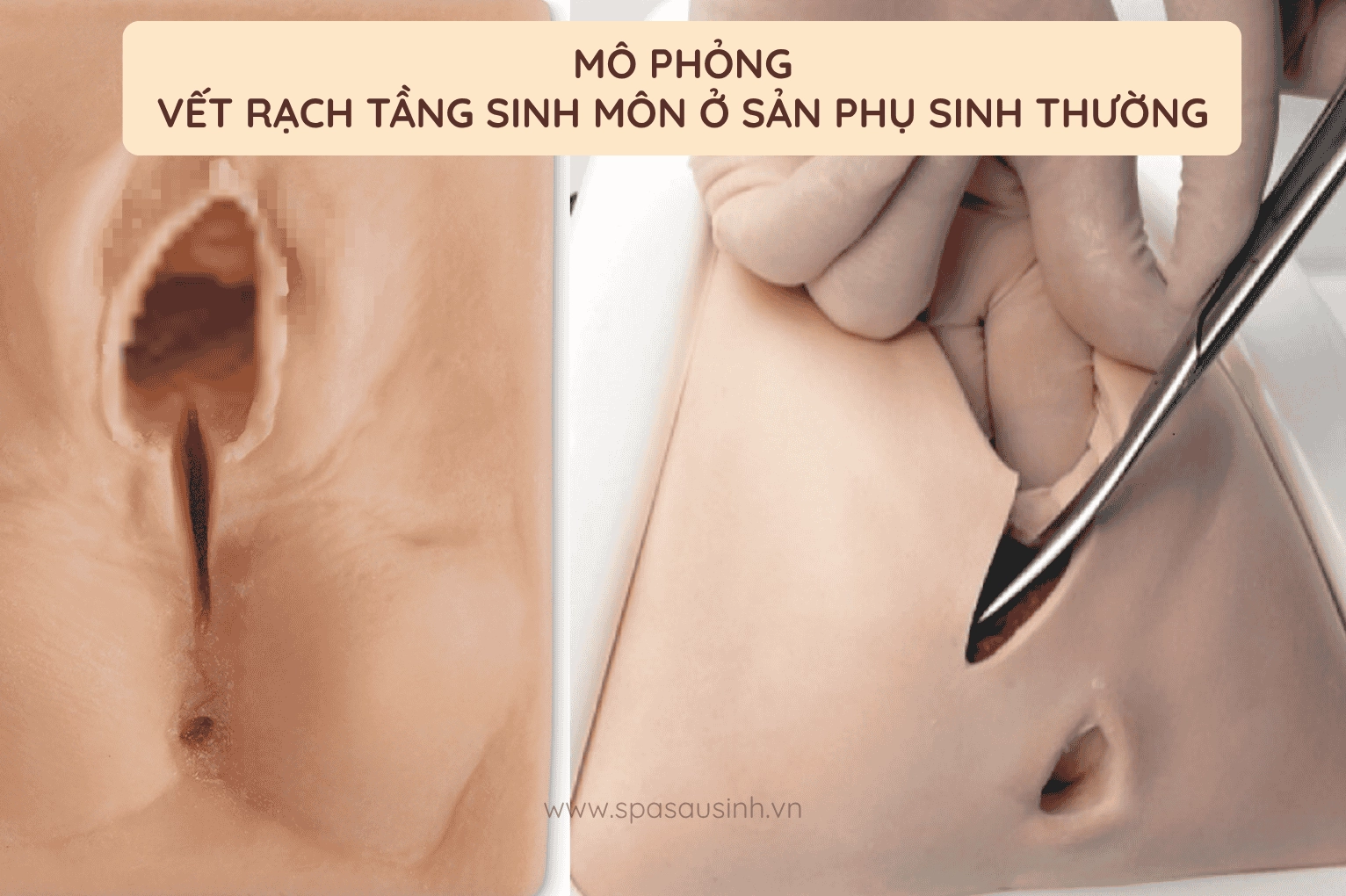 Hình ảnh minh họa vết rách tầng sinh môn sau sinh thường