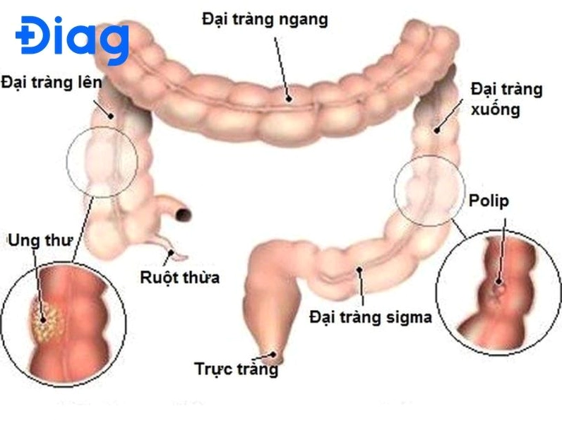 Hình ảnh ung thư đại tràng sigma