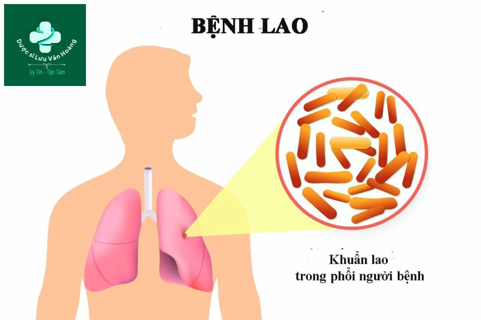 Hình ảnh vi khuẩn lao Mycobaterium tuberculosis