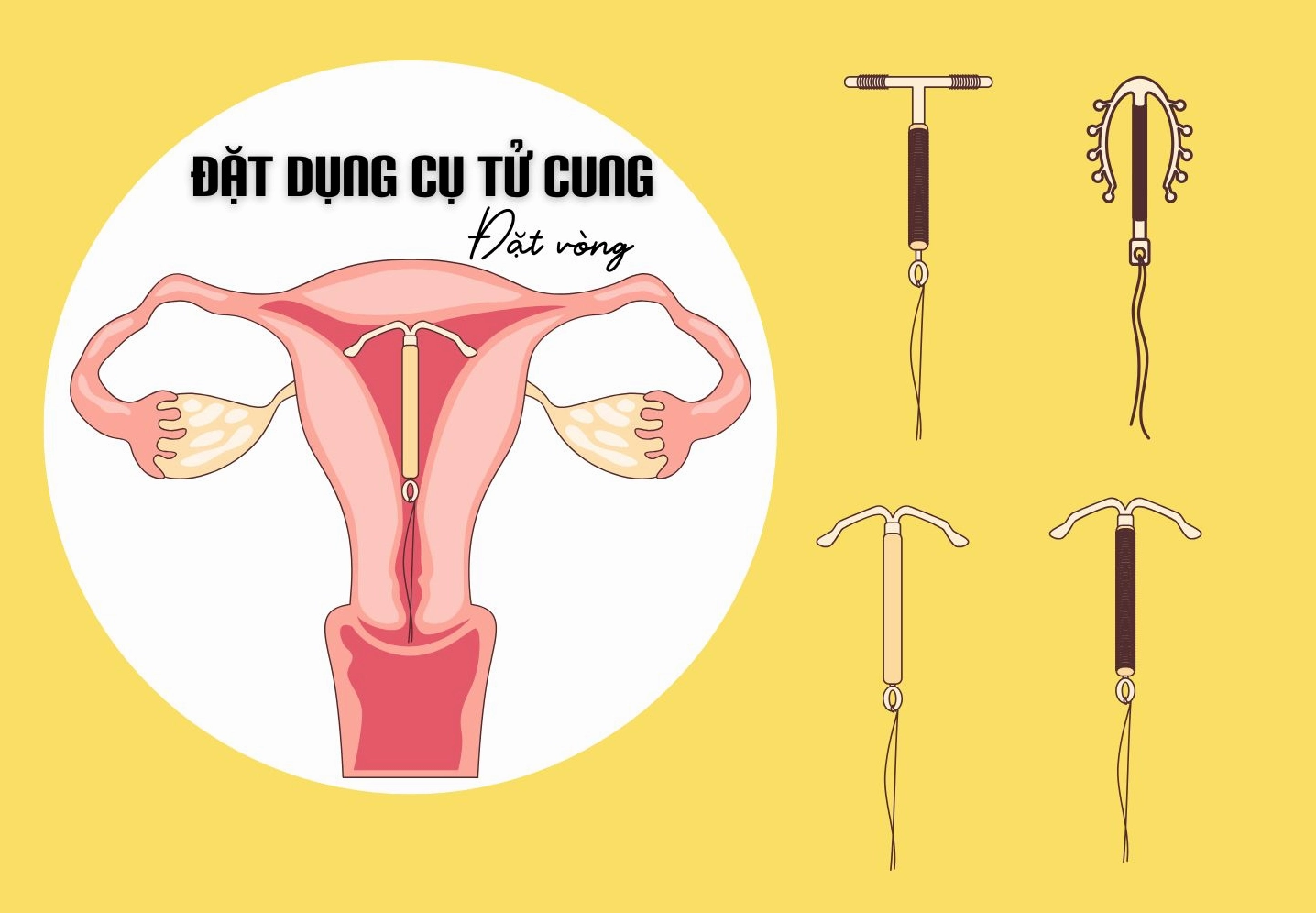 Minh họa các loại vòng tránh thai