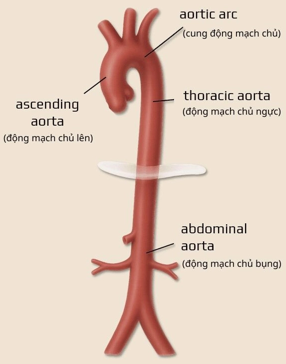 Minh họa dòng chảy máu trong động mạch chủ