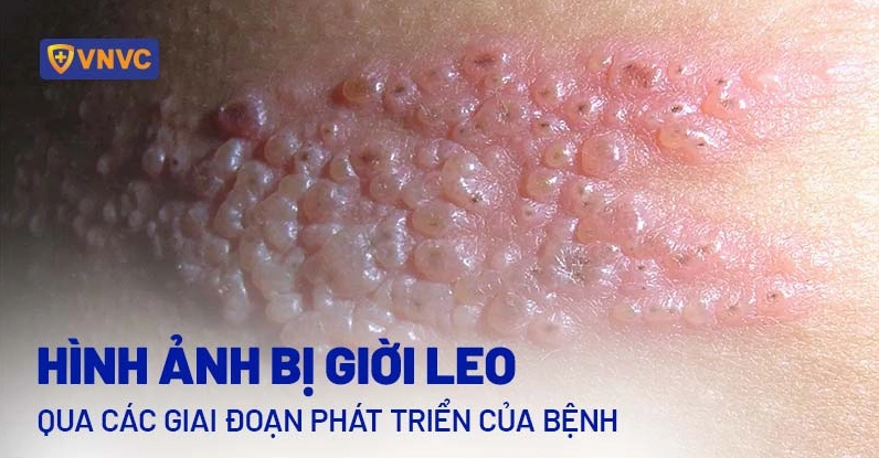 Mụn nước đặc trưng của bệnh giời leo