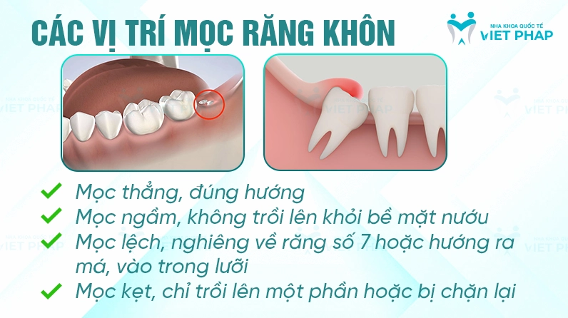 rang-khon-moc-o-au-va-nhung-ieu-can-biet-nam-2026_707