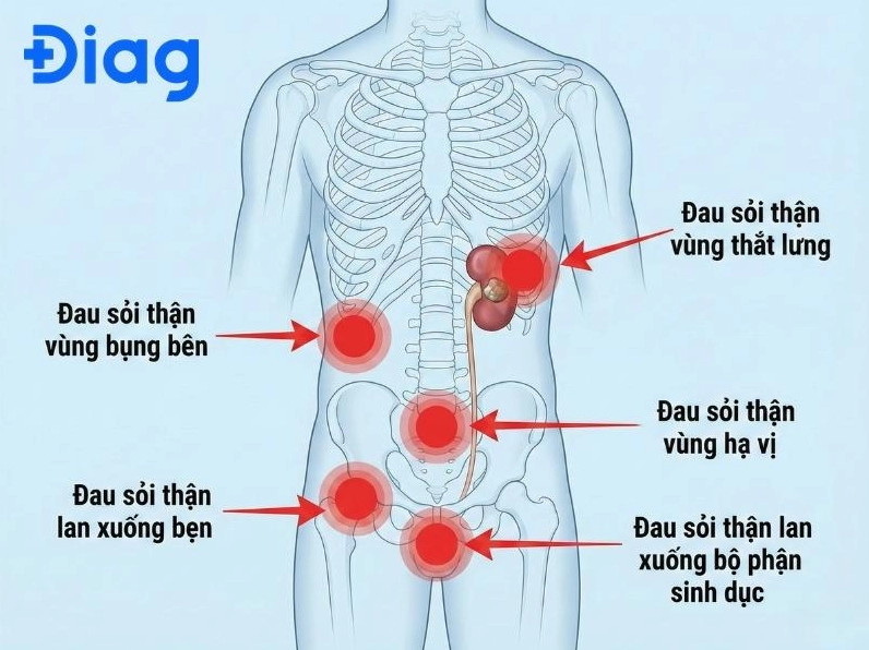 Sỏi thận đau lan xuống vùng sinh dục nam giới