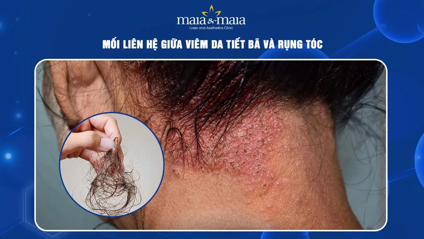 Tình trạng rụng tóc do viêm da tiết bã da đầu