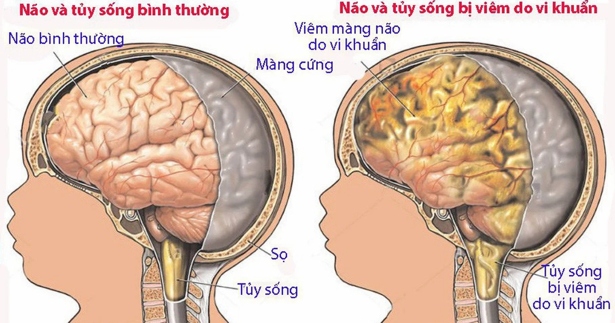 viem-mang-nao-la-gi-nguyen-nhan-trieu-chung-cach-phong-ngua-_413
