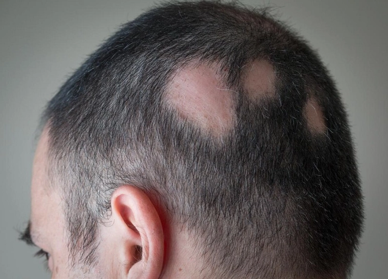 Vòng đời sợi tóc và tình trạng rụng tóc bất thường